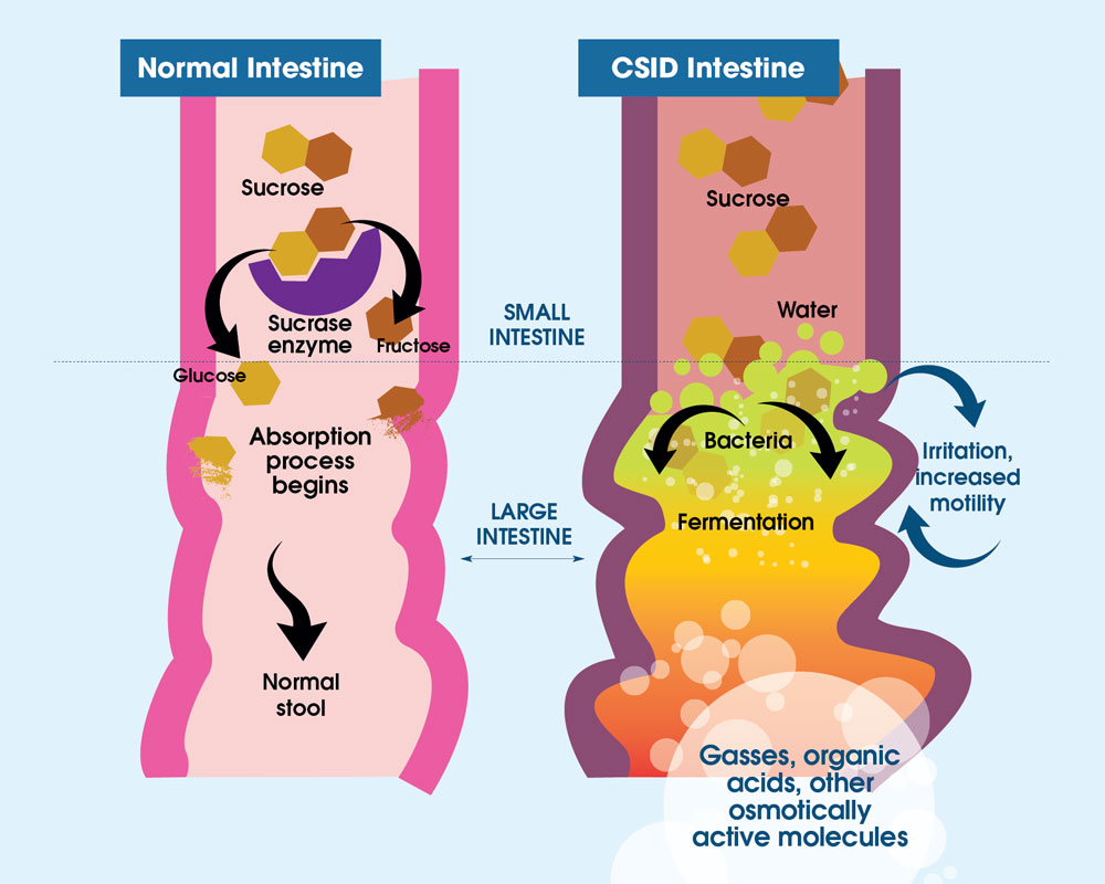 Read More About CSID A Carbohydrate Digestion Disorder Read More About CSID A Carbohydrate Digestion Disorder